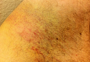 Bruised thigh